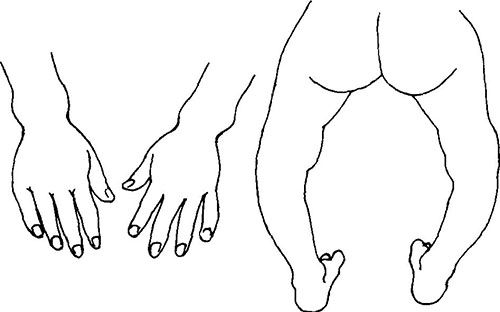 佝偻病的一些预防与治疗