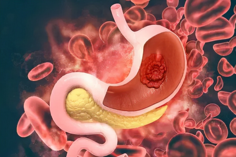 胃癌是疲劳引起的吗,胃癌晚期乏力头晕挺厉害能活多久