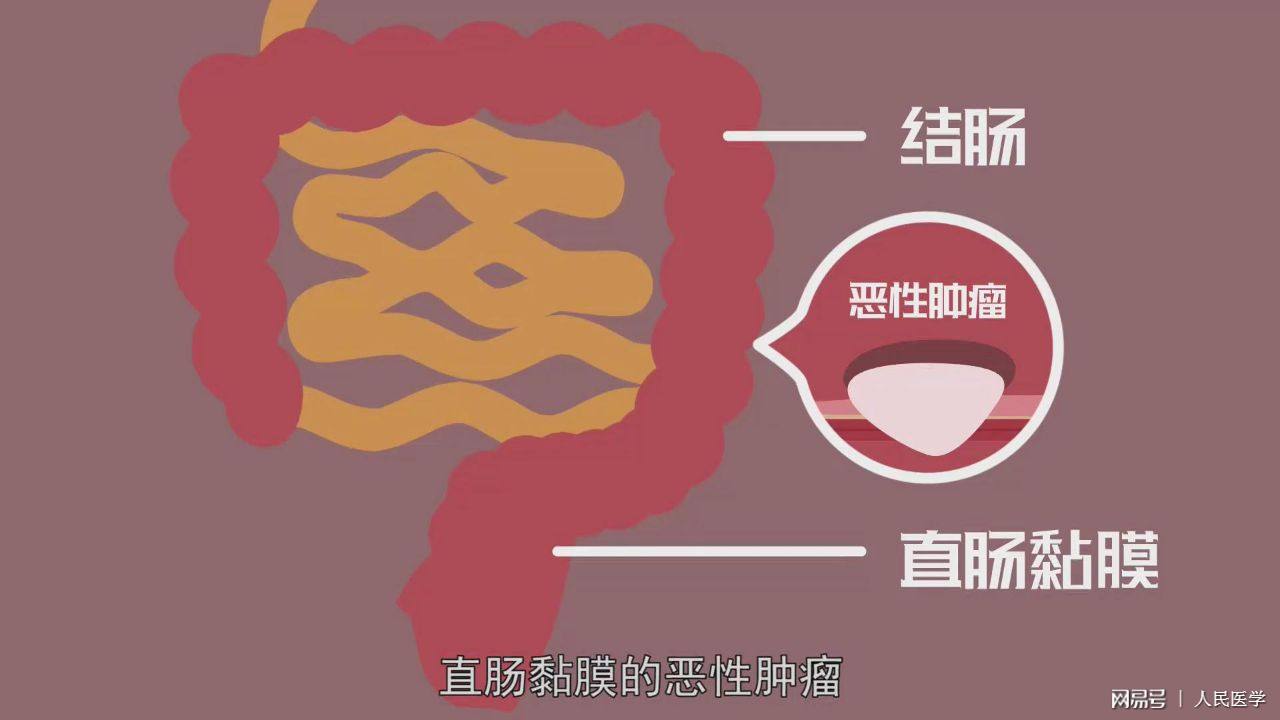 大便拉不干净总有便意是什么原因,觉得大便排不干净老有便意怎么办