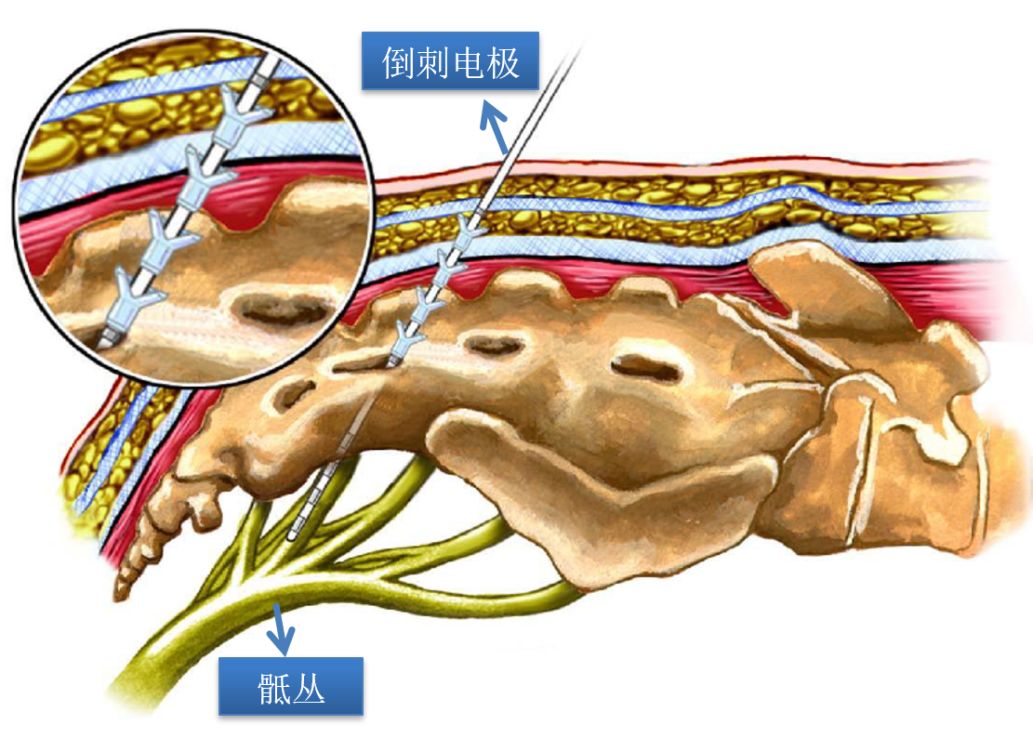 下肢截瘫康复成功案例,全国治疗截瘫最新突破