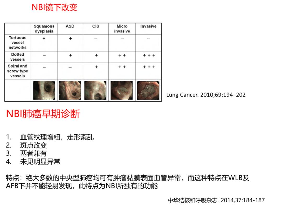 小细胞肺癌的气管镜介入治疗,导航支气管镜在肺癌诊断中的应用