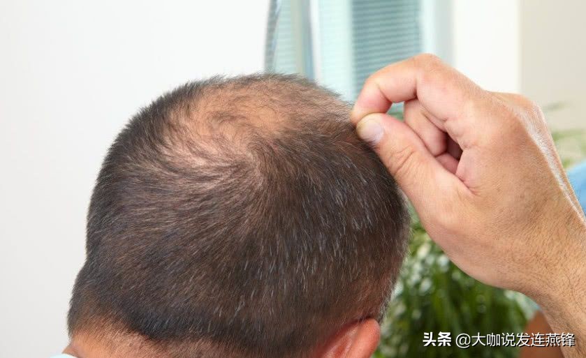 头发稀少发质软塌怎么打理,男生发量少细软免打理的发型