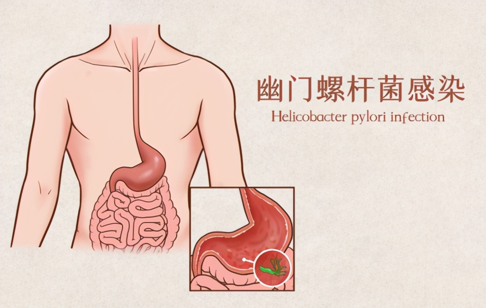 溃疡病新药,溃疡病特效西药