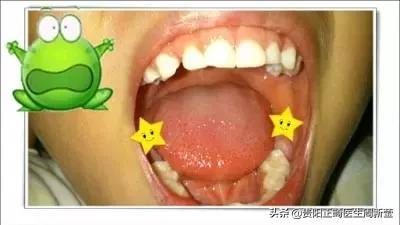12岁前必须解决的错颌畸形,孩子十二岁牙畸形怎么办