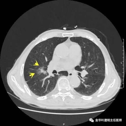 多发原发肺癌能根治吗,肺部原发性恶性肿瘤好治
