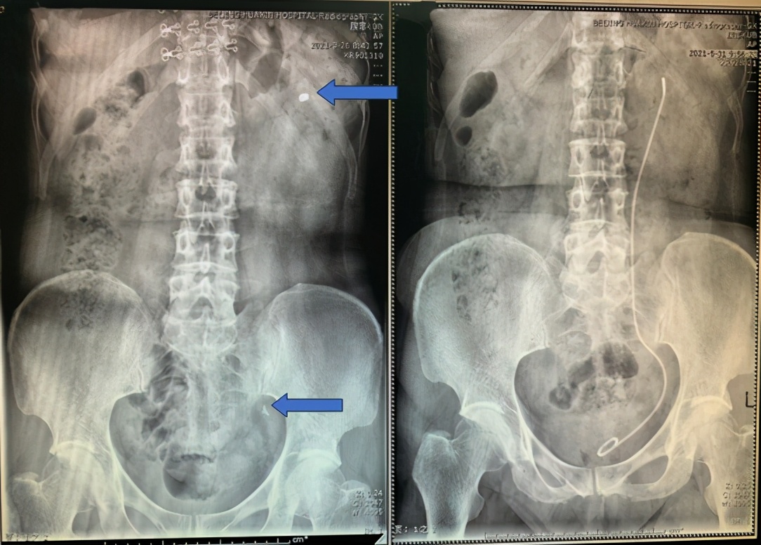 尿路结石ct复查,尿路感染进了icu