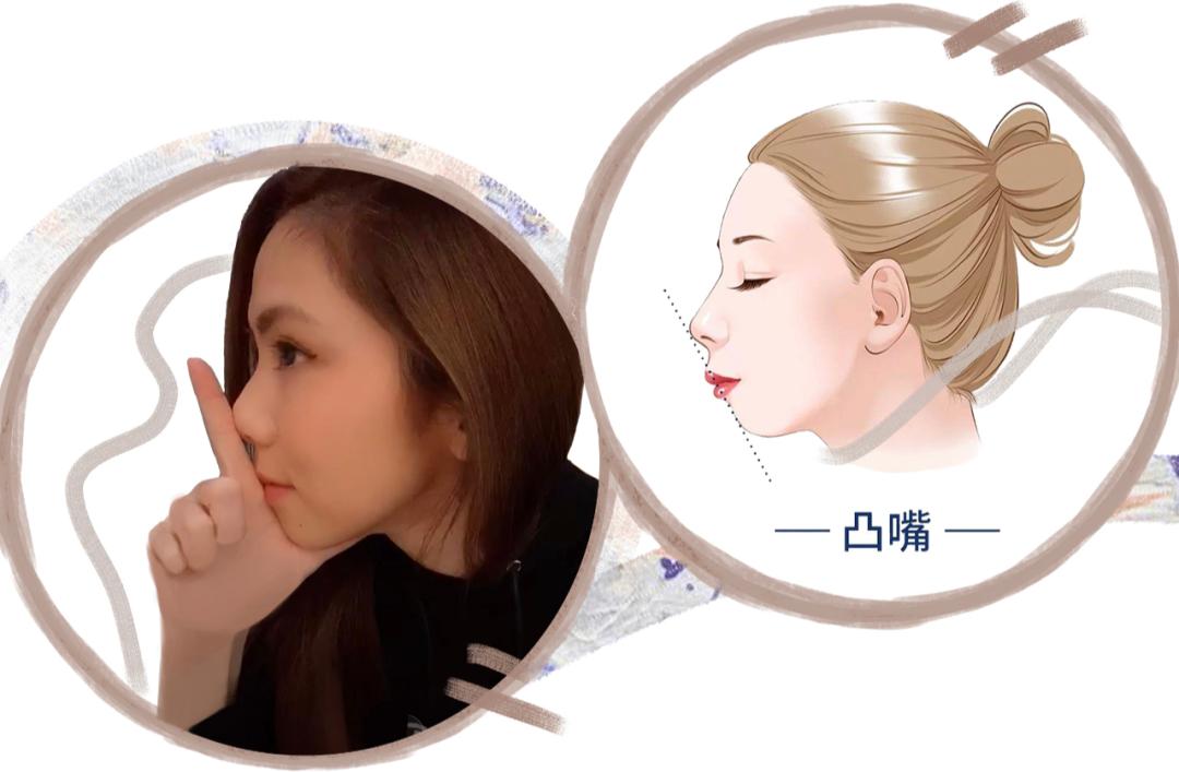 被丑哭了怎么办,被凸嘴拉低颜值怎么改善