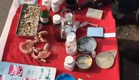 江湖无痛拔牙方法,真正的无痛拔牙