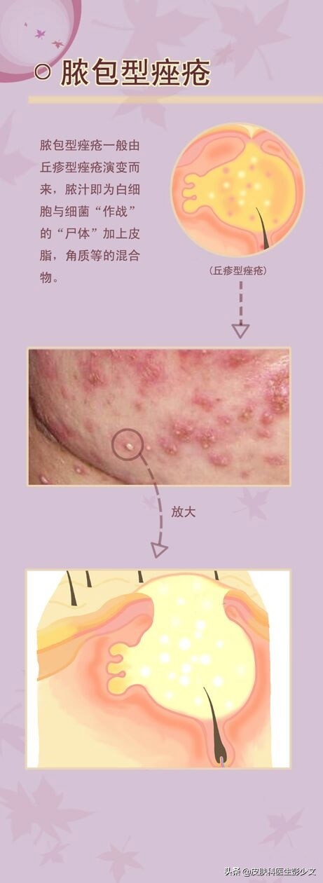 连续十年不停的长痘疮是怎么回事,身上长痘疮怎么治疗