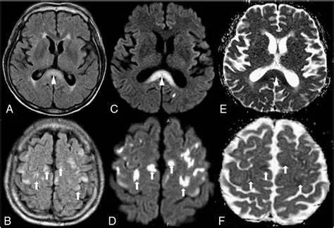 胼胝体有什么症状,胼胝体形态较小可以治疗吗