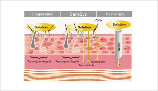 现在流行的美容打什么针,美容上的微针是怎么回事