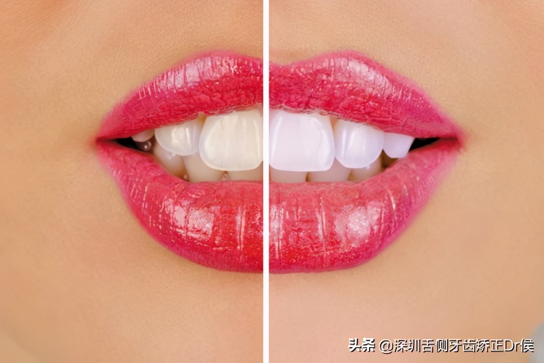 牙齿美白去黄的最快方法,牙齿美白最好的方法用什么牙膏
