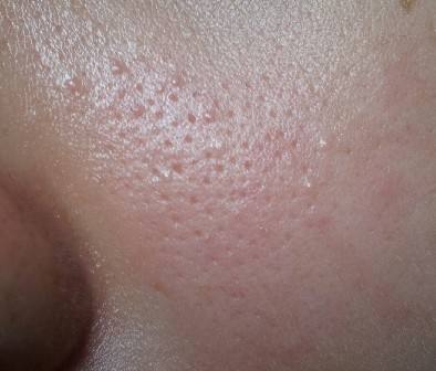 毛孔粗大怎么办教你一招,毛孔粗大怎么办护肤步骤