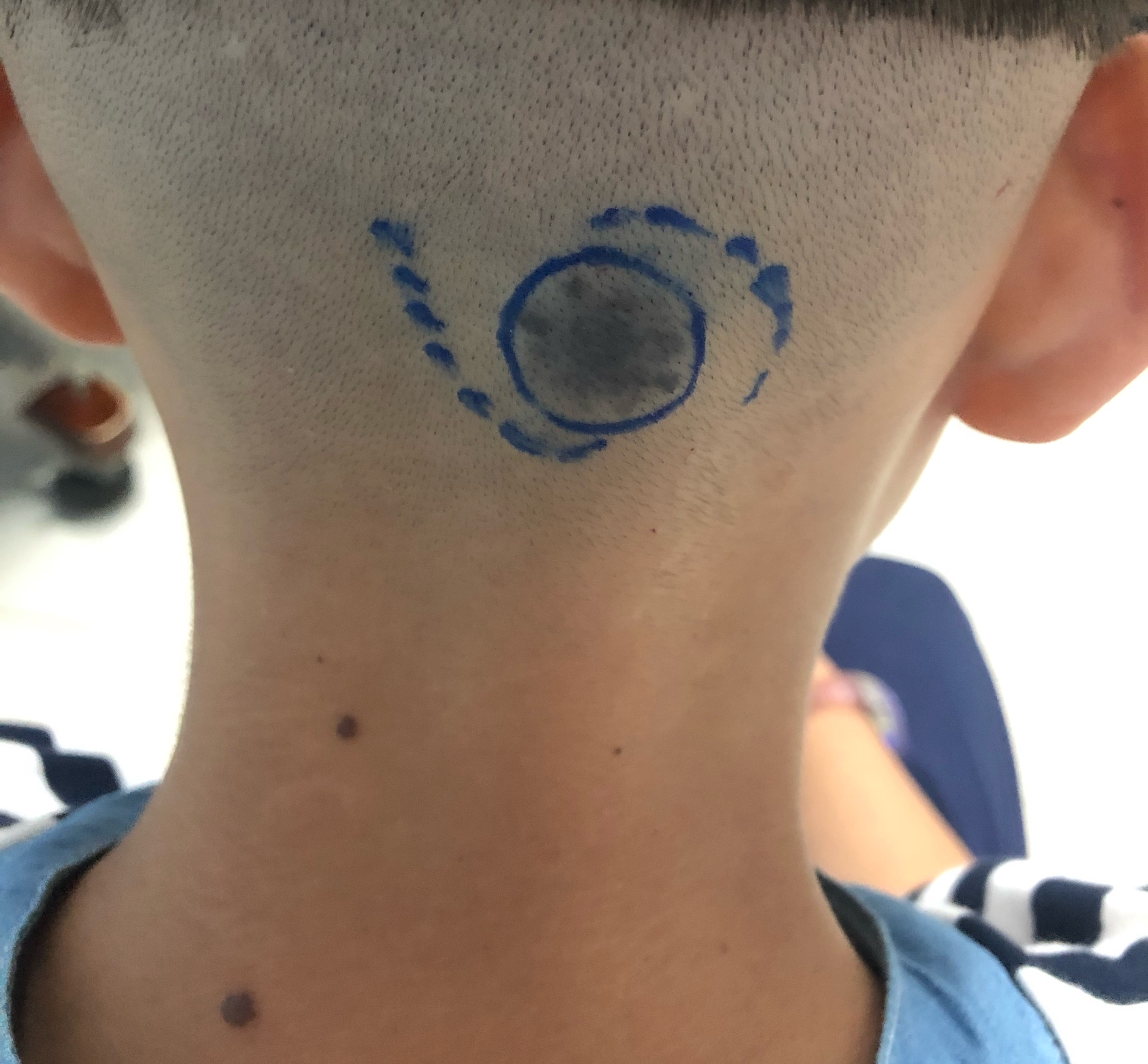 三厘米的痣手术切除要不要做皮瓣,头皮上有个凸起的痣要不要切除