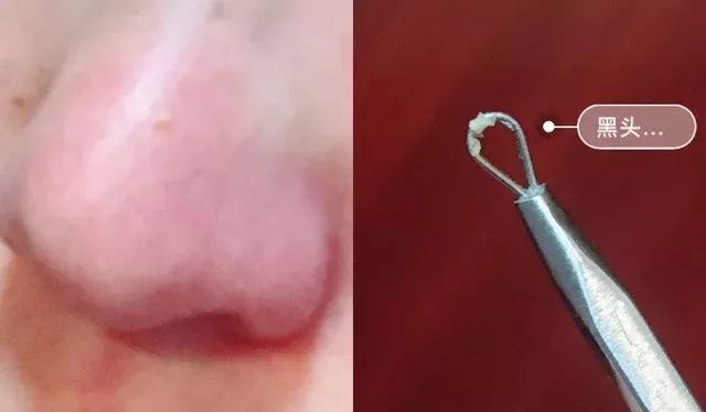 脸上的黑头粉刺挤不出来怎么办,脸部黑头粉刺有必要去美容院挤吗