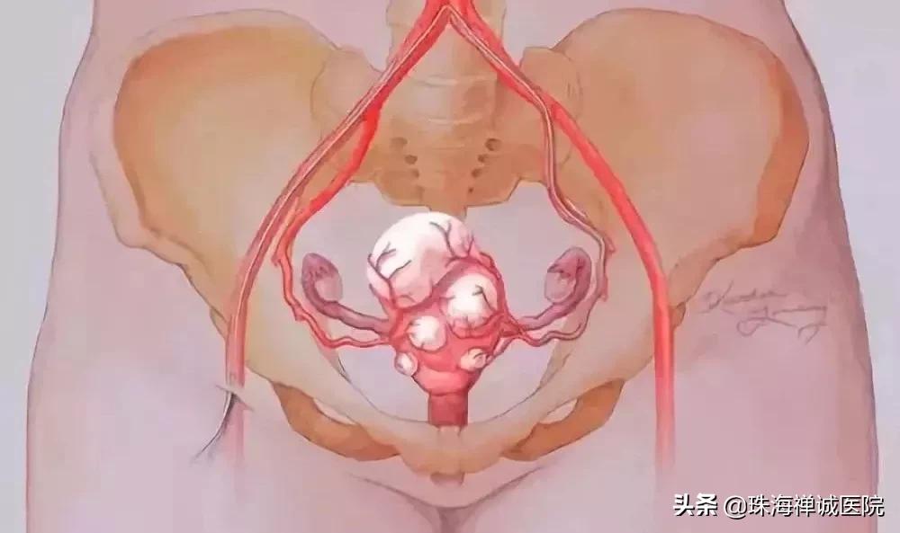 子宫肌瘤治疗的必要性,心脏病能做子宫肌瘤手术吗