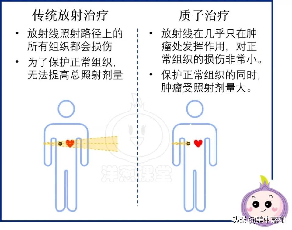 旋转束质子肿瘤放射治疗系统,肿瘤放射治疗