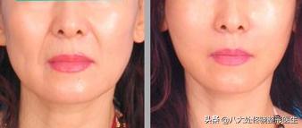 眼窝填充自体脂肪和玻尿酸哪个好,鼻唇沟凹陷物理改善方法