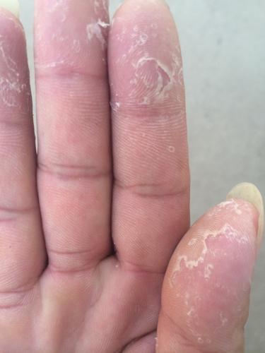 手秋冬脱皮脱得很严重怎么办,一到秋天手就脱皮怎么办