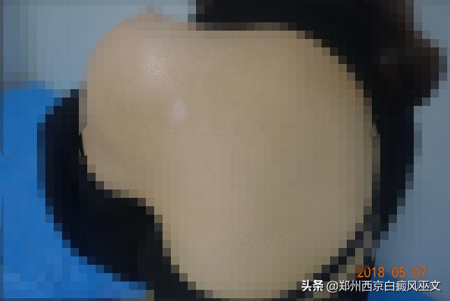 白癜风早期分型图,白癜风的病例描述