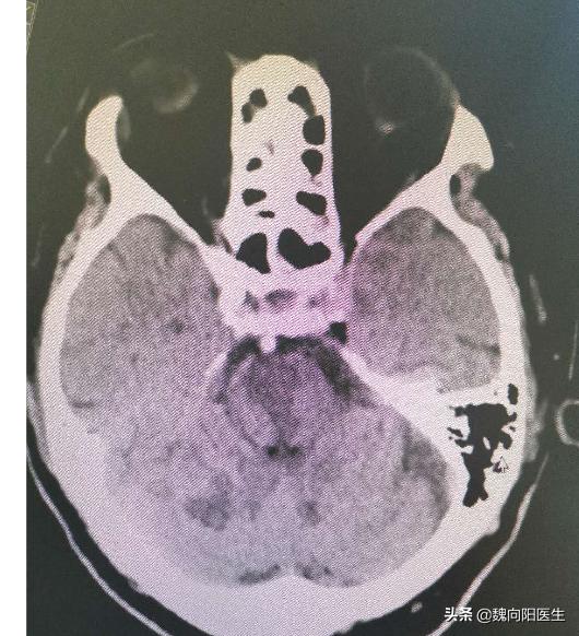 耳眩晕是什么疾病,眩晕常见疾病之梅尼埃