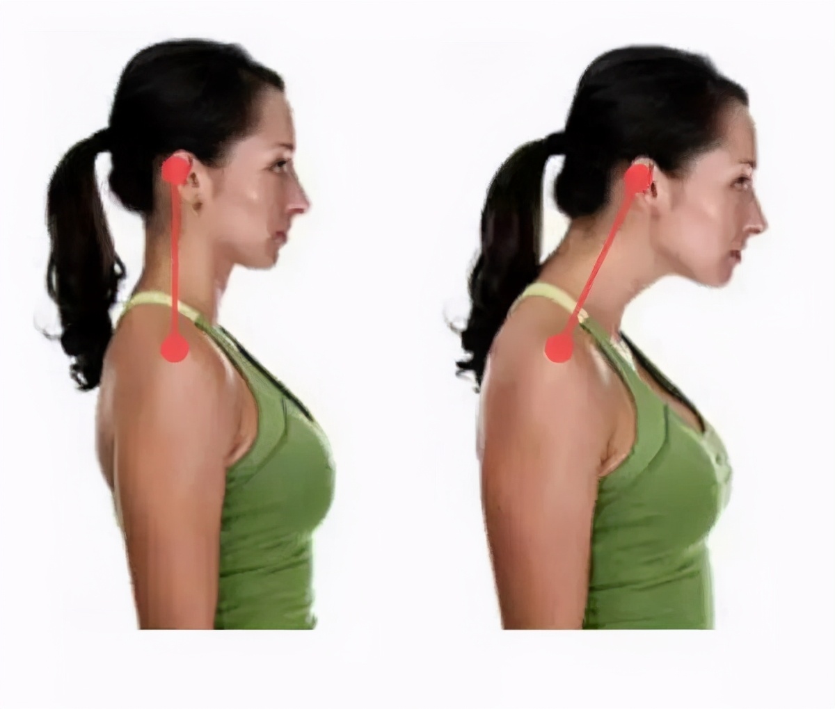 脖子前倾乌龟颈怎么改善,乌龟颈怎么锻炼最有效