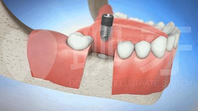 种植牙是什么种植技术,种植牙一般要怎么种植的