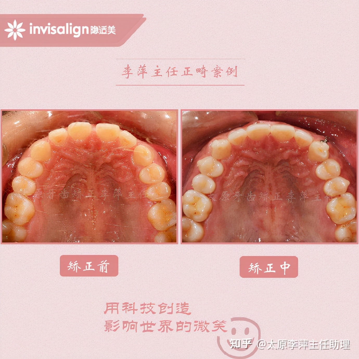 重度拥挤矫正牙齿适合隐形牙套吗,广州成人牙齿矫正推荐隐形牙套