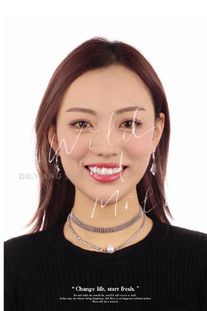 牙齿美学修复的缺点,大龄牙齿矫正经历和感受