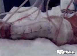 伤口换药技术操作流程视频,如何换药包扎伤口