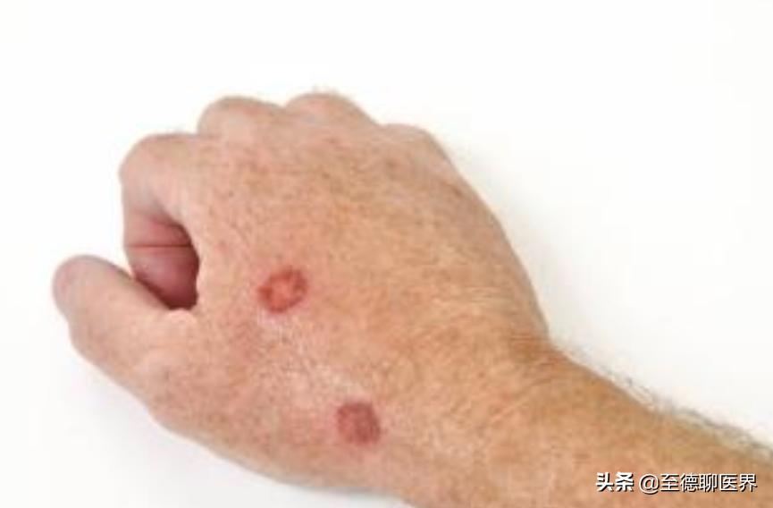 赵忠祥讲述鳞状细胞癌,赵忠祥鳞癌治疗方法