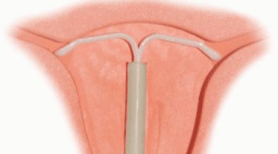 来姨妈痛得蜷成虾，老公居然还说是装的！这种病，要早看