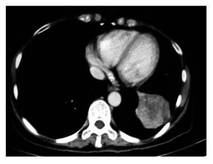 注射治愈癌症,肺癌晚期用什么针药能减轻痛苦