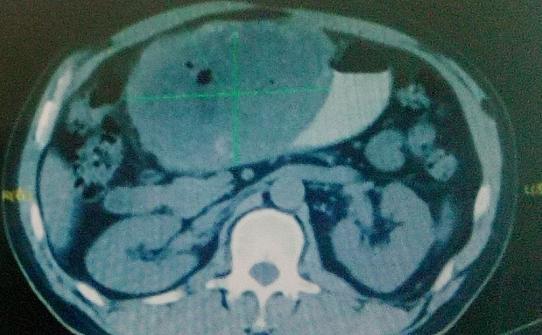 巨型肝癌从查出到死真实情况,肝癌10厘米治愈案例