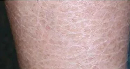 脚后跟鱼鳞状干裂怎么治疗,脚后跟像鱼鳞一样一层层干裂中医