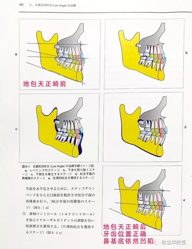 法令纹鼻基底填充玻尿酸方法,鼻基底底法令纹深怎么整