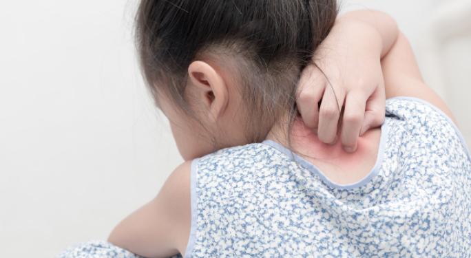 儿童得银屑病治好后长大还会得吗,儿童银屑病生物制剂贵吗