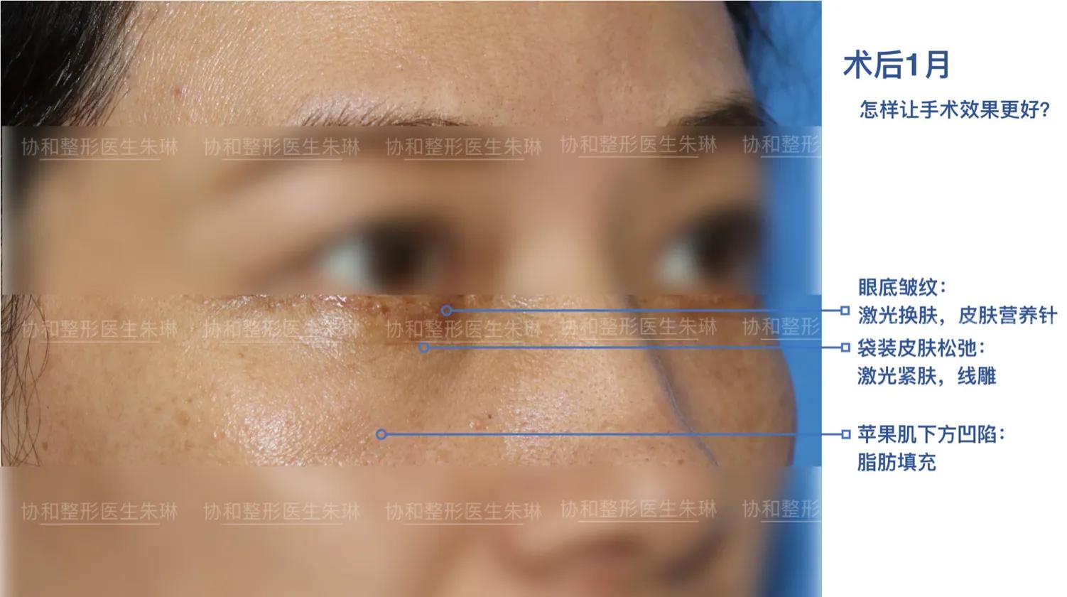 外切眼袋消肿食谱,外切眼袋20天效果图