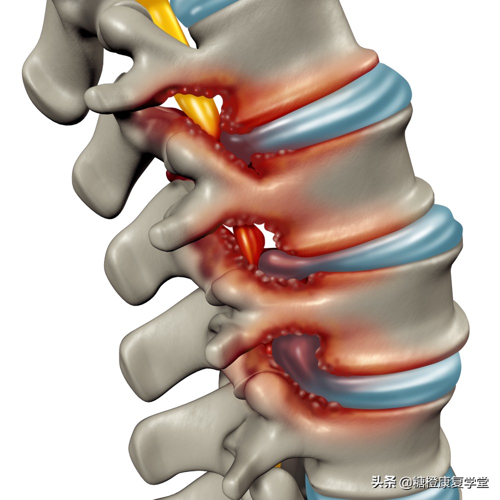 脊柱侧弯头疼怎么缓解,脊柱侧弯什么程度会肩膀疼
