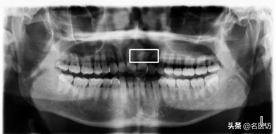 矫正科普|美人在骨不在皮，从神秘的牙片看牙齿和侧貌颜值