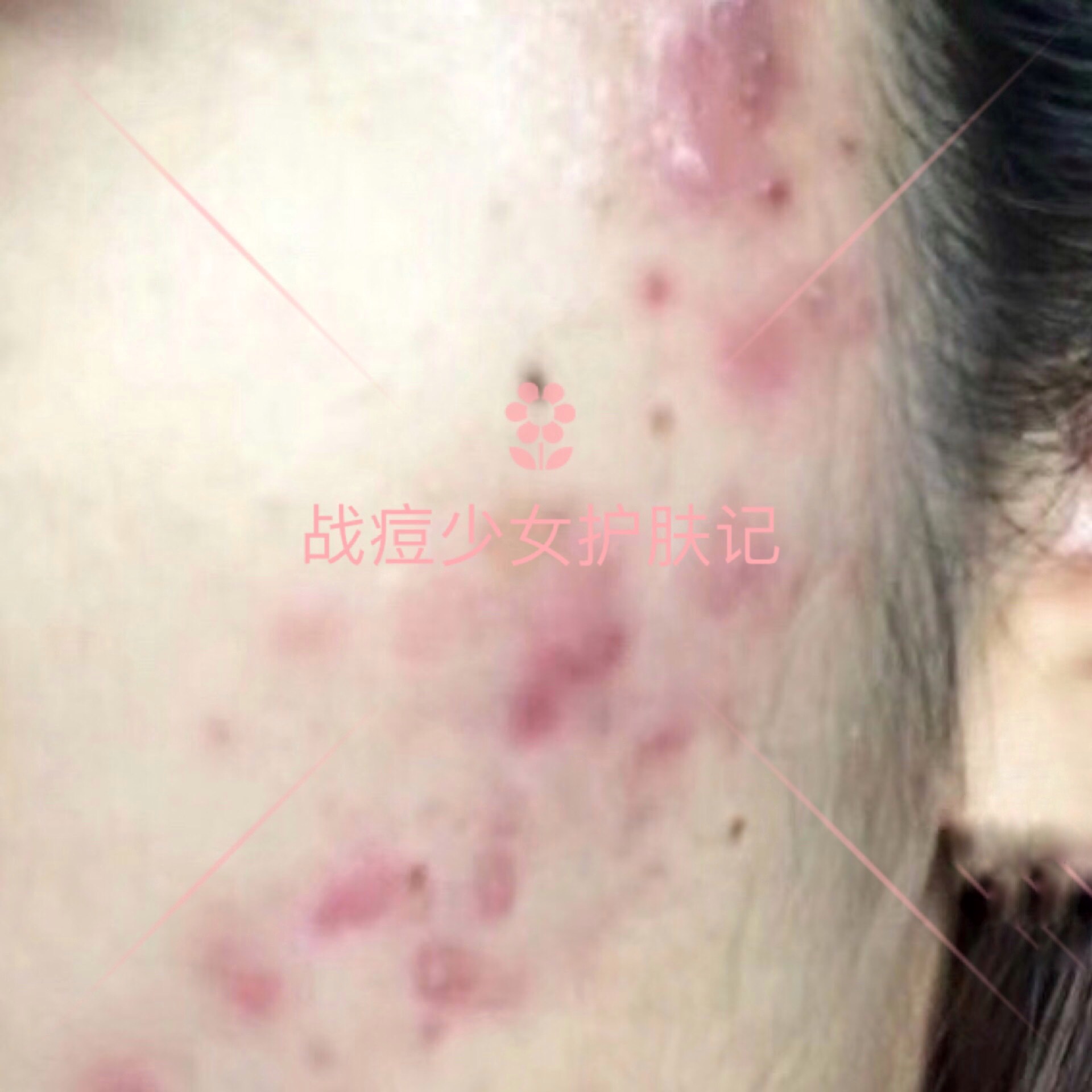 四种痘痘最佳治疗方法,各种痘痘的对症用药