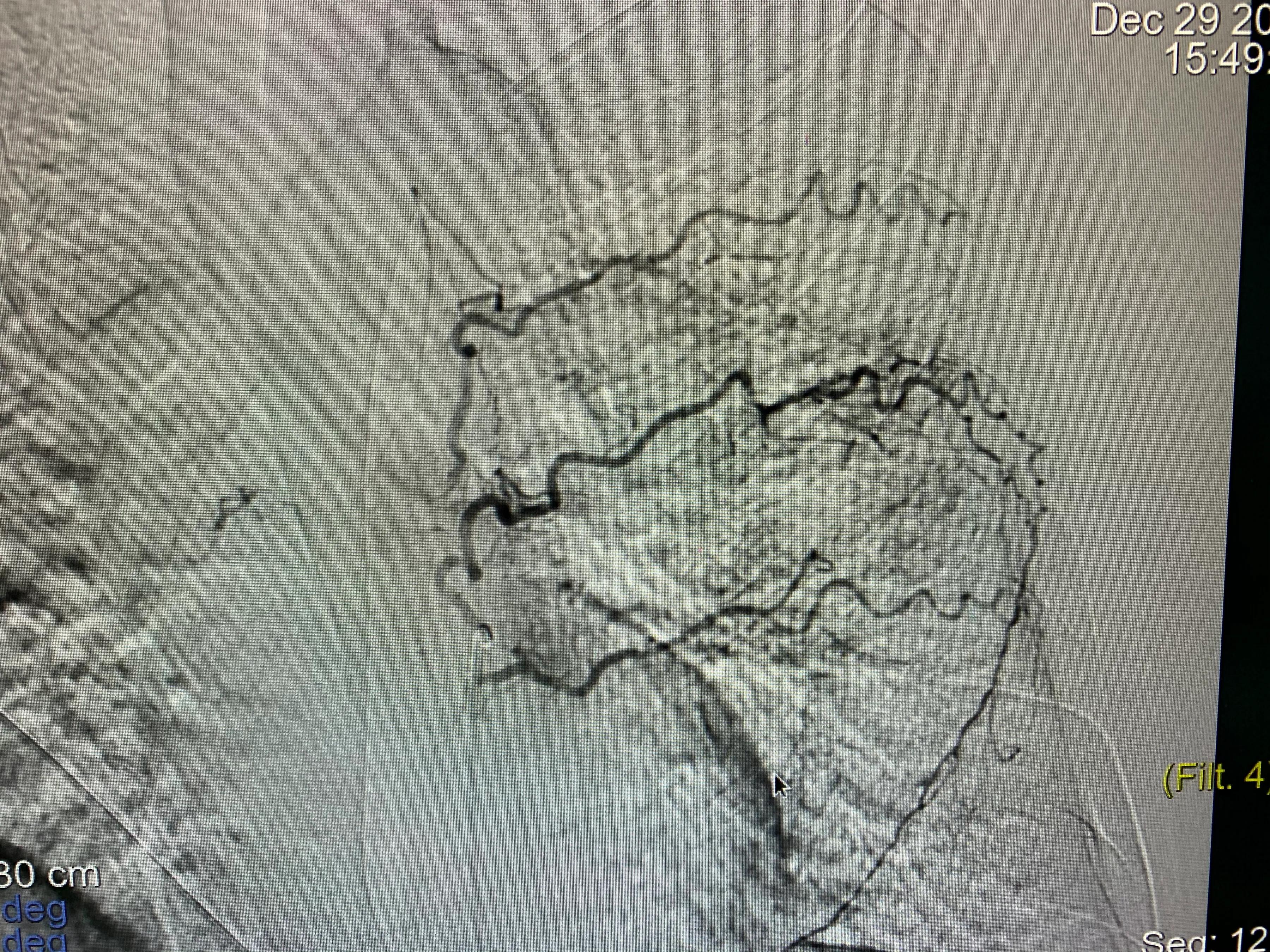 肺癌栓塞的介入治疗,84岁老人患肺癌可以做微创介入吗