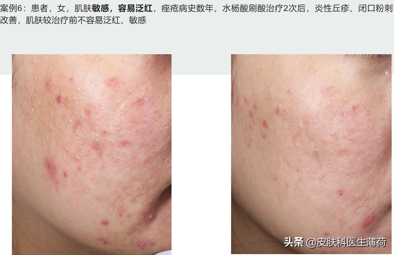 水杨酸果酸毛孔收缩精华测评,水杨酸精华适合所有痘肌