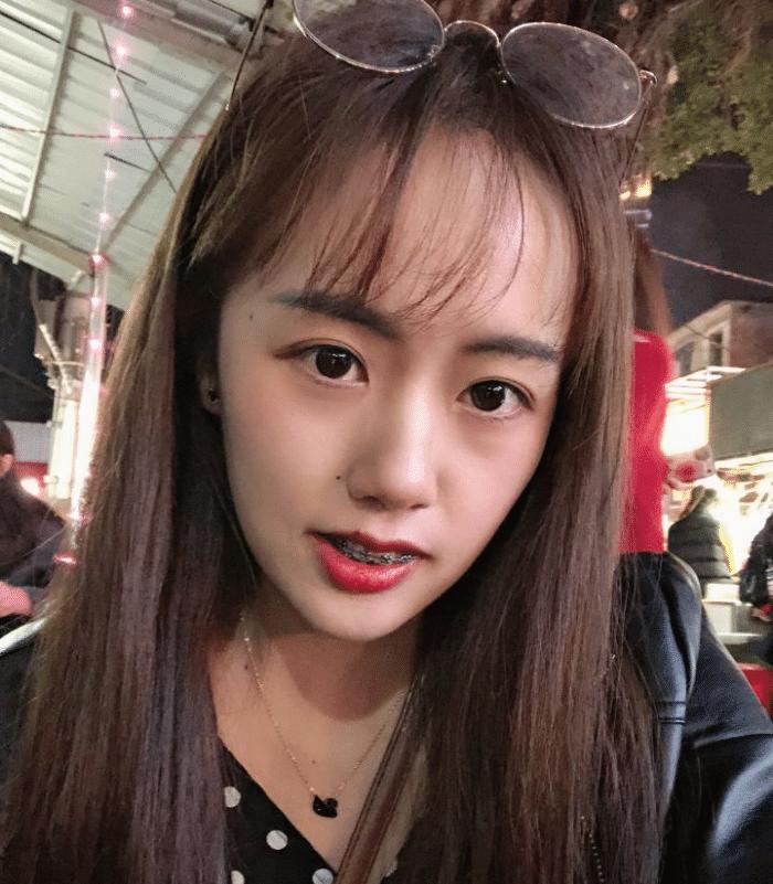 牙套隐形日记,牙套日记正颌