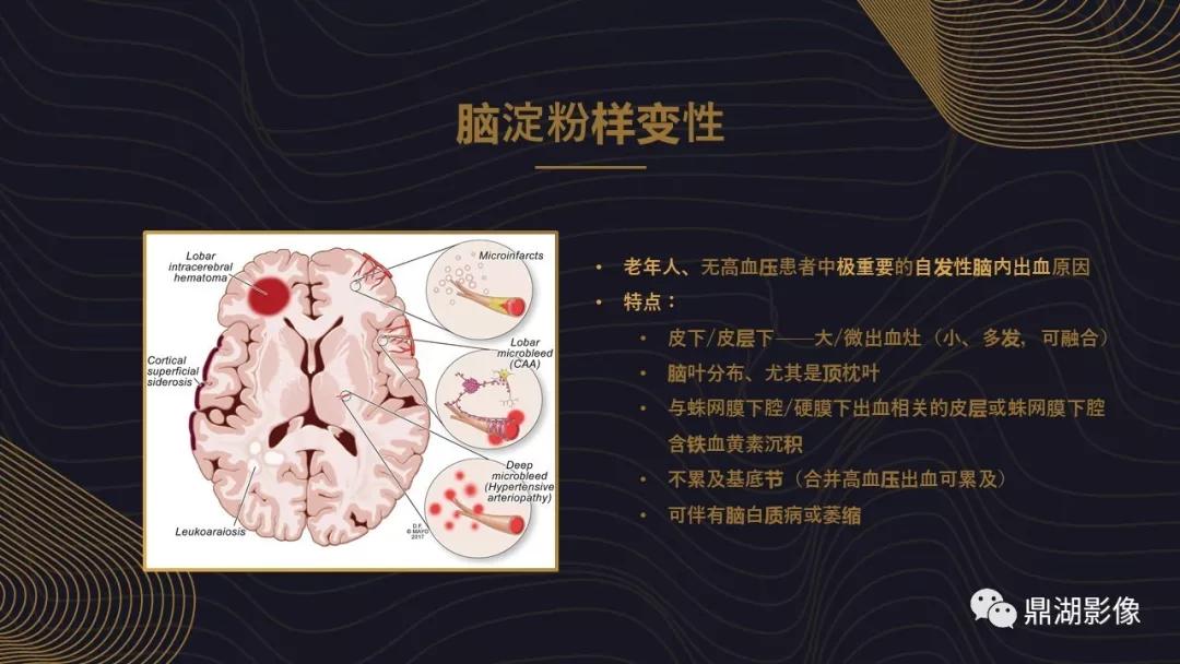 不简单|脑出血超详细学习笔记