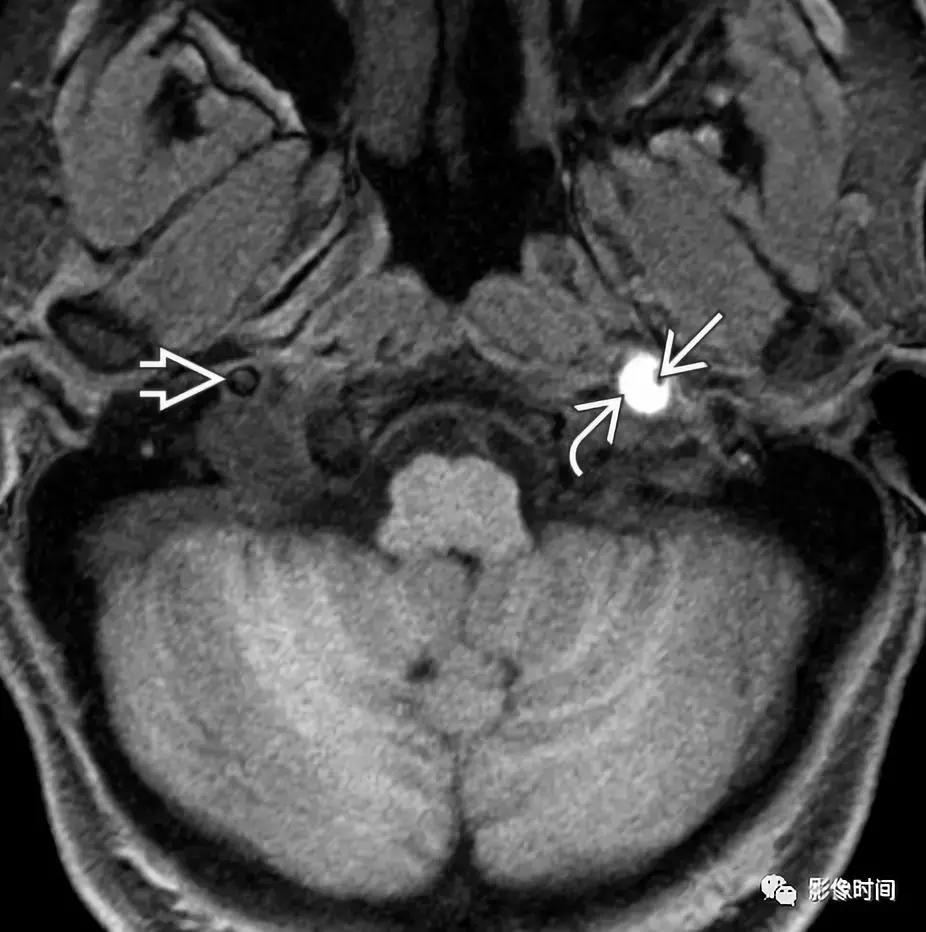 双侧颈动脉鞘间隙多发小淋巴结影,双侧颈动脉间隙多软组织密度结节