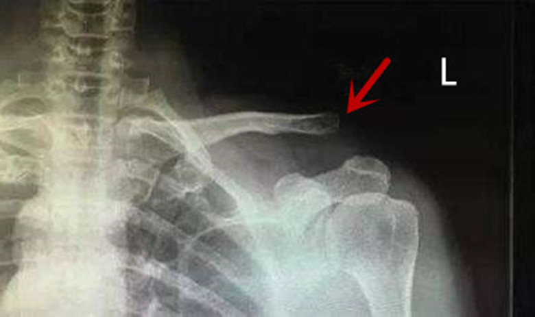 肩膀疑似脱位但是ct显示正常,肩关节脱位术后又翘起来了