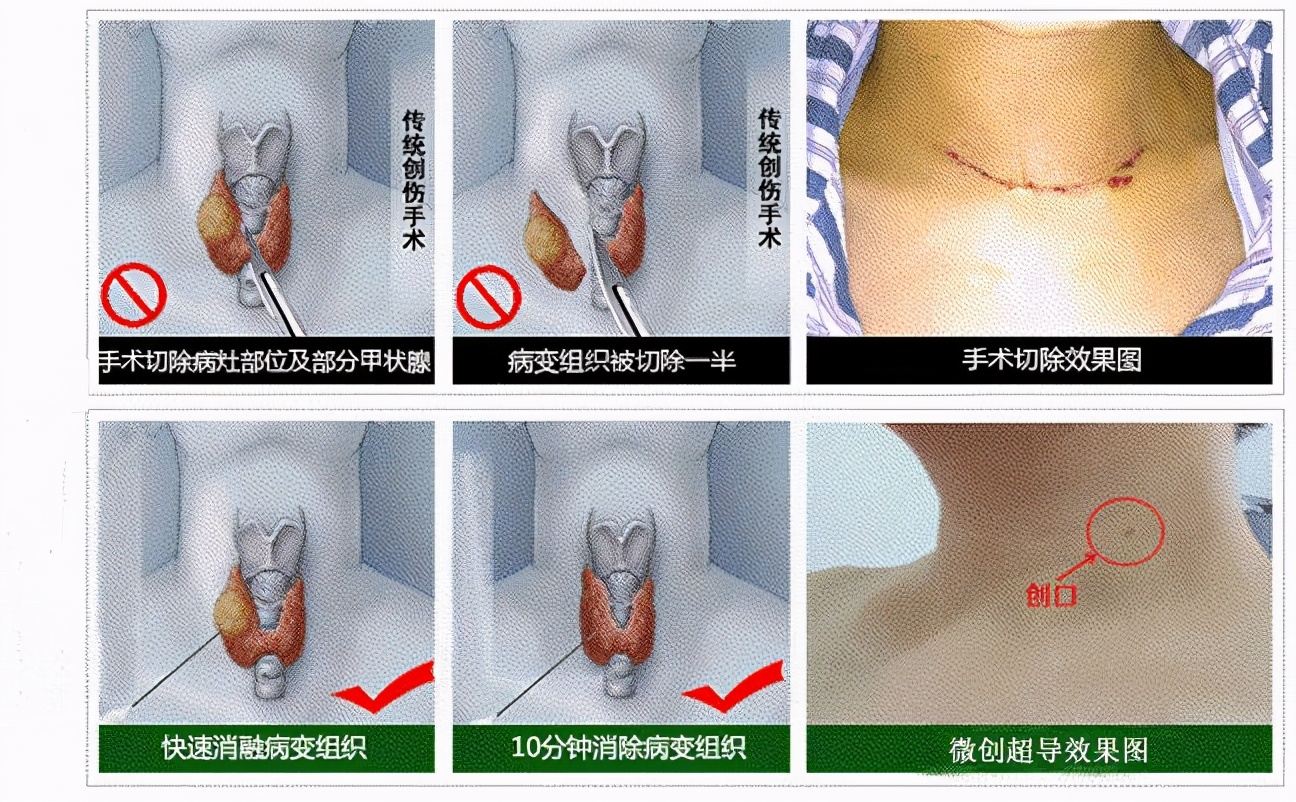 这种方法治甲状腺结节，创口只有“针眼”大