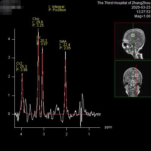 漳州市第三医院预约做磁共振,3.0t核磁共振广东哪里可以做