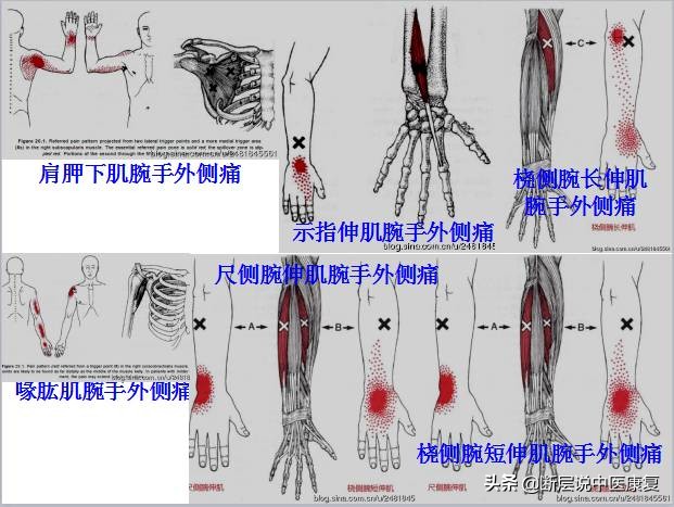 激痛点挂图,激痛点疗法笔记